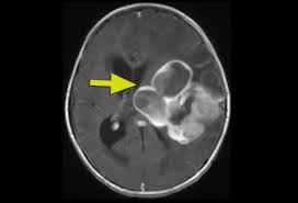 Glioma Surgery